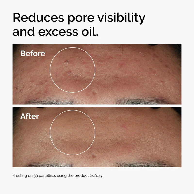 Ordinary's Niacinamide 10% + Zinc 1% Serum