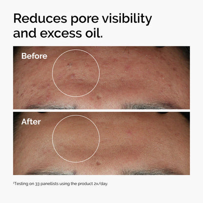 Ordinary's Niacinamide 10% + Zinc 1% Serum